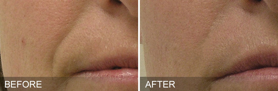 wrinkle reduction revers aging laser treatments