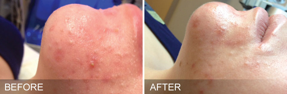 acne treatments skin clinic ocala